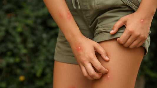 Woman outdoors that is covered in mosquito bites and itching leg.